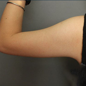 整形前后对比图片