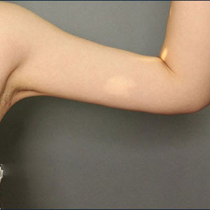 整形前后对比图片