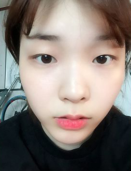 整形前后对比图片