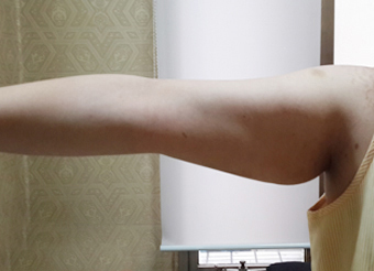 整形前后对比图片