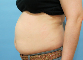 整形前后对比图片