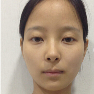 整形前后对比图片