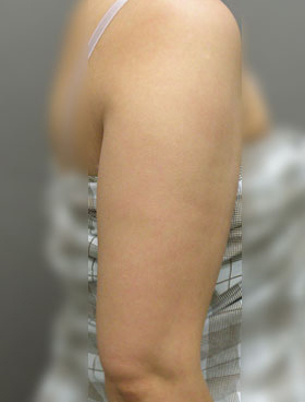 整形前后对比图片