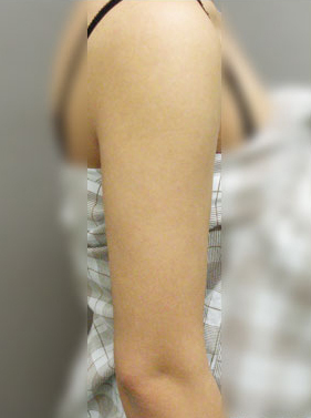 整形前后对比图片