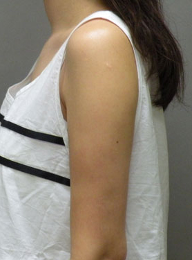 整形前后对比图片