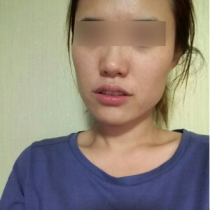 整形前后对比图片