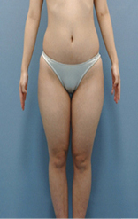 整形前后对比图片