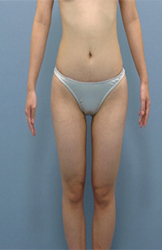 整形前后对比图片