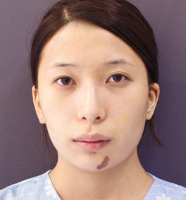 整形前后对比图片