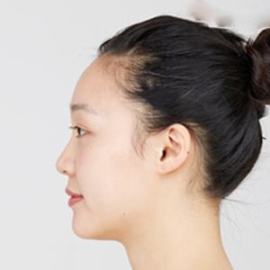 整形前后对比图片