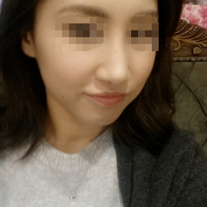 整形前后对比图片