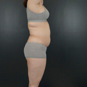 整形前后对比图片