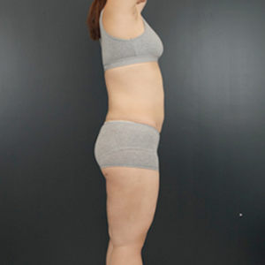 整形前后对比图片