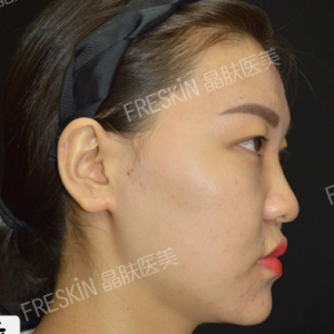 整形前后对比图片