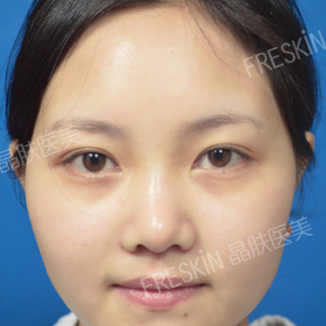 整形前后对比图片