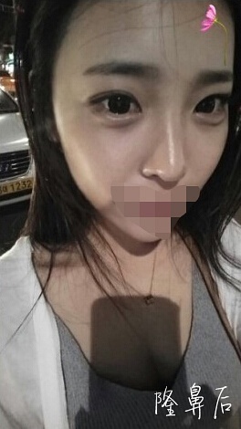 整形前后对比图片