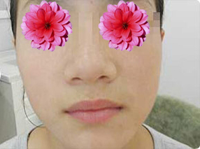 整形前后对比图片