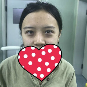 整形前后对比图片