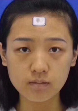 整形前后对比图片