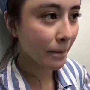 整形前后对比图片