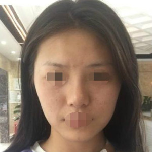 整形前后对比图片