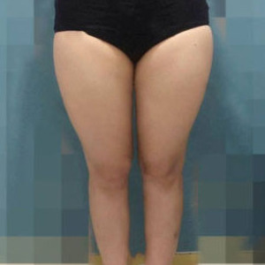 整形前后对比图片