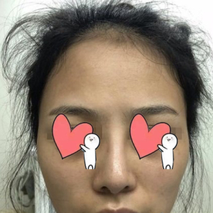 整形前后对比图片