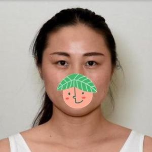 整形前后对比图片