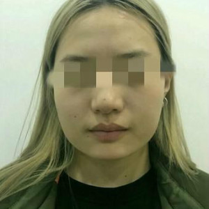 整形前后对比图片