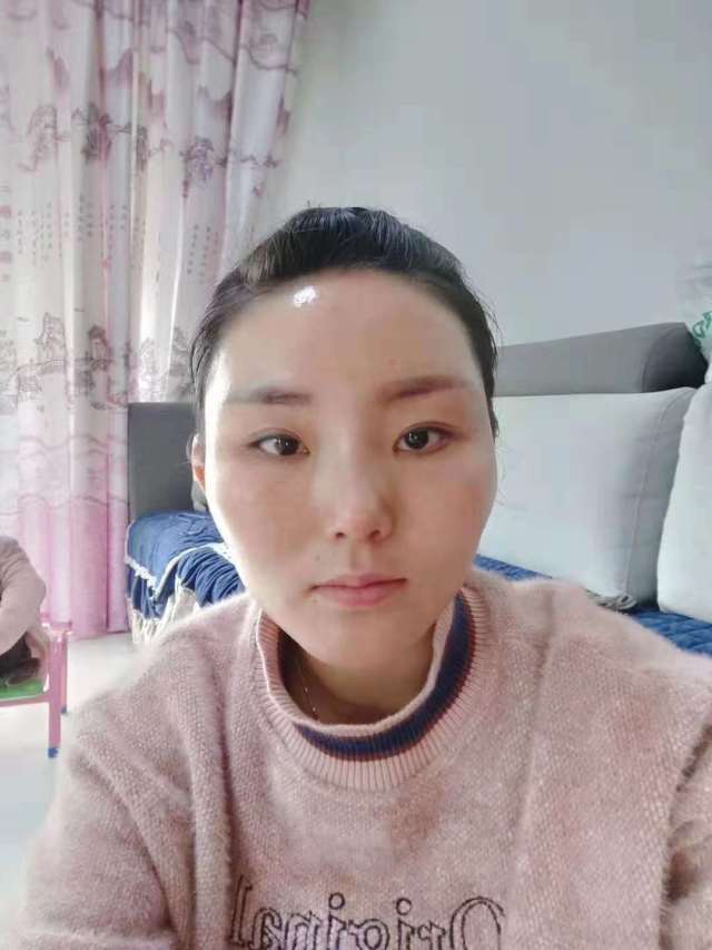 宿佳的整形术后图片