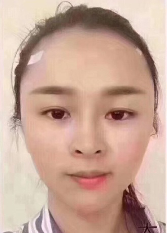 双婷的整形术后图片
