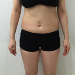 整形前后对比图片