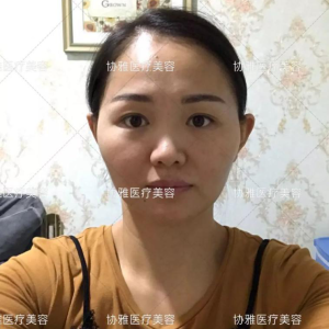 整形前后对比图片