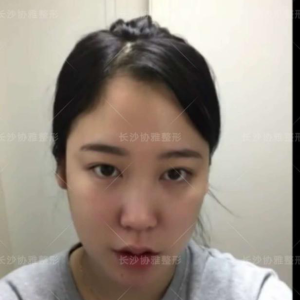 整形前后对比图片