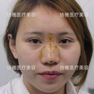 整形前后对比图片