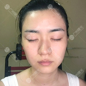 整形前后对比图片