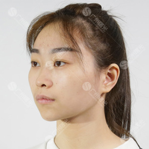 整形前后对比图片