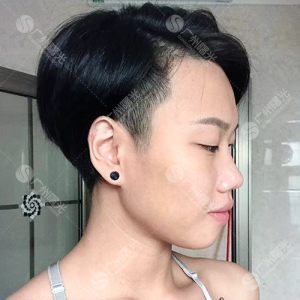 整形前后对比图片