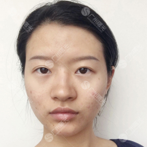 整形前后对比图片