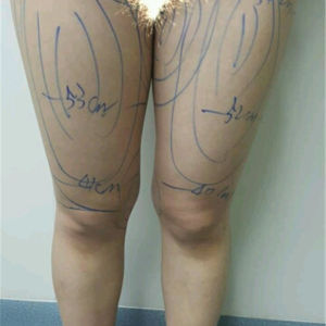 整形前后对比图片