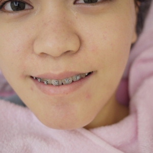 整形前后对比图片