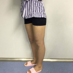 整形前后对比图片