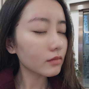 杨明露的整形术后图片