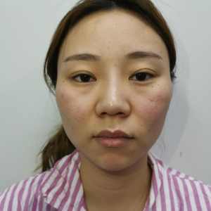 整形前后对比图片