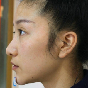 整形前后对比图片