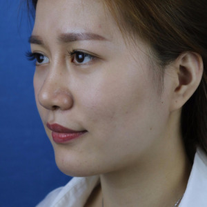 整形前后对比图片