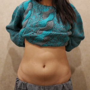 整形前后对比图片