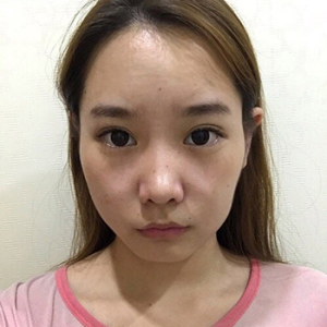 整形前后对比图片