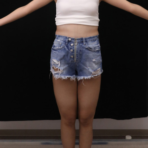 整形前后对比图片