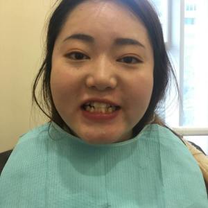 整形前后对比图片